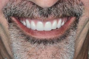 implant dental restoration