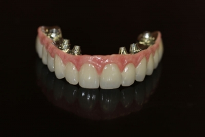 Implant supported full arch restoration