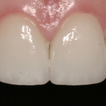 Single central dental restoration