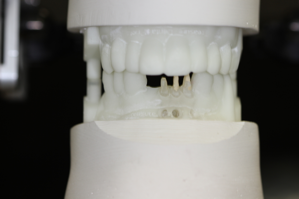 Digital Impression for Teeth