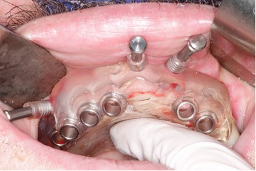 360 dental implant