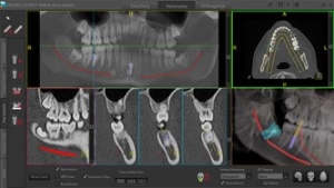 360 implant x-ray