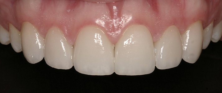 shading a single central tooth