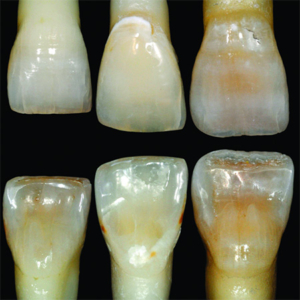 central incisor