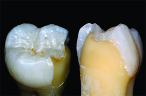 Enamel Dentin cutout