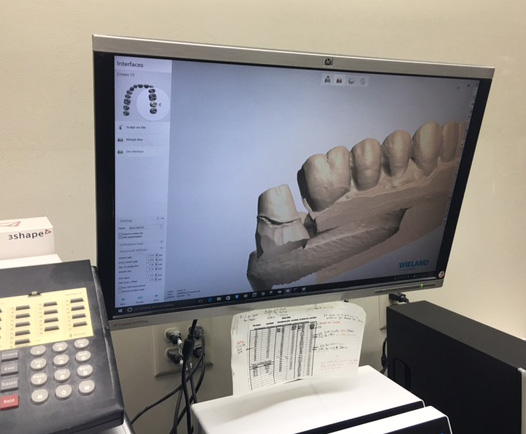 dental lab digital impression