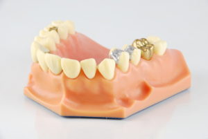 gold dental fillings